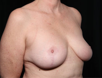 Breast Reduction Before & After Patient #33052