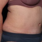 Tummy Tuck Before & After Patient #33063