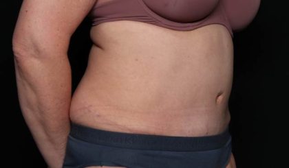 Tummy Tuck Before & After Patient #33063