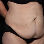 Liposuction Before & After Patient #33174