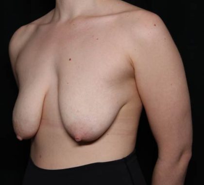 Breast Lift Before & After Patient #33085