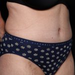 Liposuction Before & After Patient #33174