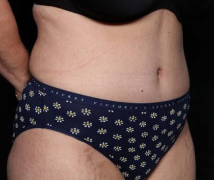 Liposuction Before & After Patient #33174
