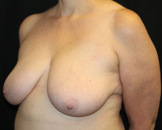 Breast Reduction Before & After Patient #33052