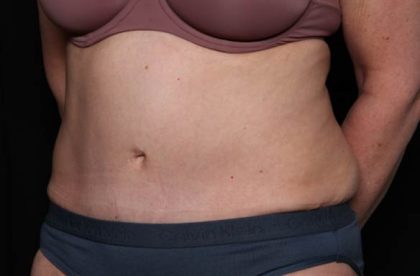 Tummy Tuck Before & After Patient #33063