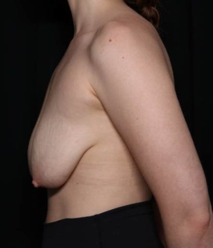 Breast Lift Before & After Patient #33085