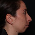 Rhinoplasty Before & After Patient #33109