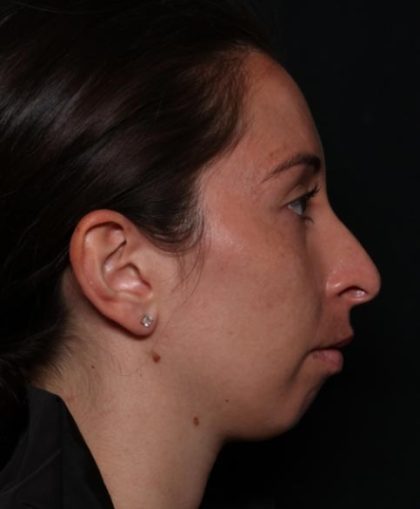 Rhinoplasty Before & After Patient #33109