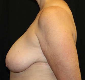 Breast Reduction Before & After Patient #33052