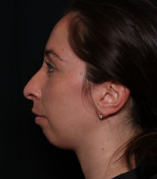 Chin Augmentation Before & After Patient #33041