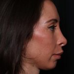 Rhinoplasty Before & After Patient #33109