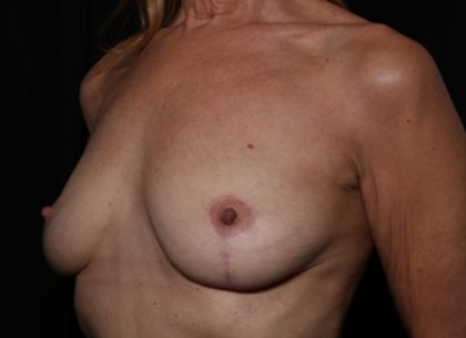 Breast Lift Before & After Patient #33185