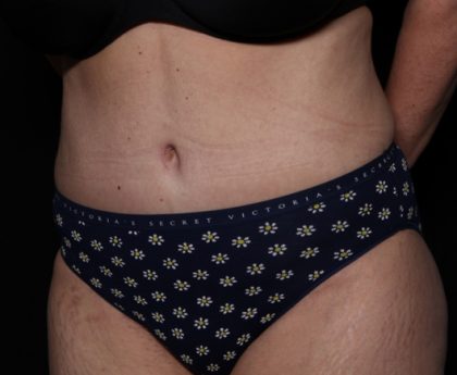 Liposuction Before & After Patient #33174