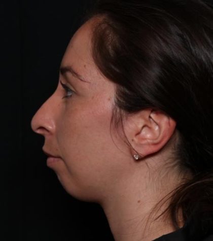 Rhinoplasty Before & After Patient #33109