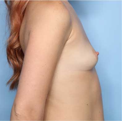 Breast Augmentation Before & After Patient #33098
