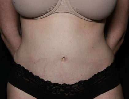 Liposuction Before & After Patient #33215