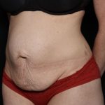 Liposuction Before & After Patient #33215