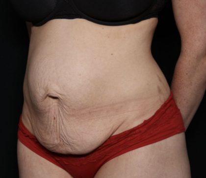 Liposuction Before & After Patient #33215