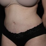 Liposuction Before & After Patient #33215