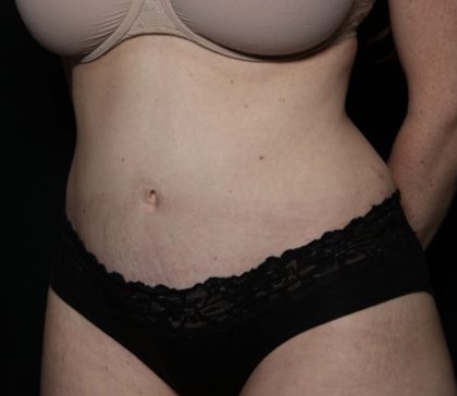 Liposuction Before & After Patient #33215