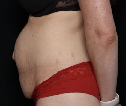 Liposuction Before & After Patient #33215