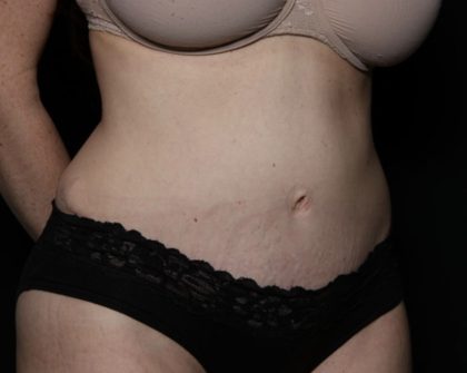 Liposuction Before & After Patient #33215