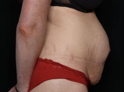 Liposuction Before & After Patient #33215