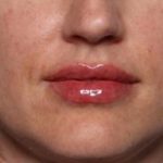 Lip Filler Before & After Patient #33160