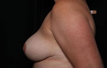 Breast Reduction Before & After Patient #33149