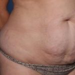 Liposuction Before & After Patient #33240