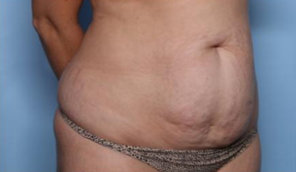 Liposuction Before & After Patient #33240