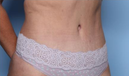 Liposuction Before & After Patient #33240