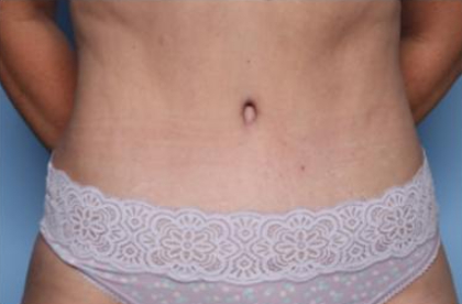 Liposuction Before & After Patient #33240