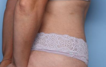 Liposuction Before & After Patient #33240