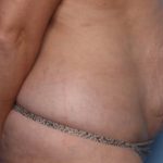 Liposuction Before & After Patient #33240