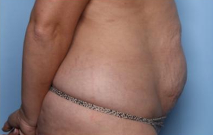 Liposuction Before & After Patient #33240