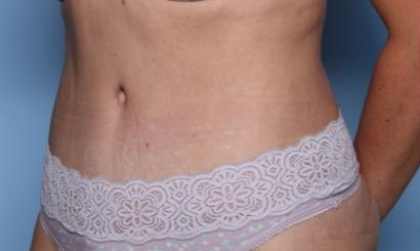 Liposuction Before & After Patient #33240