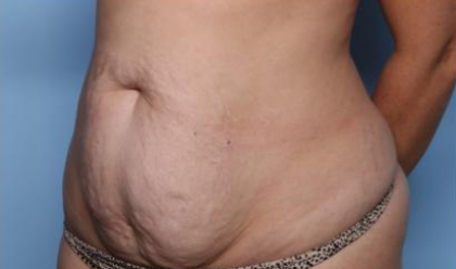 Liposuction Before & After Patient #33240