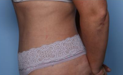 Liposuction Before & After Patient #33240