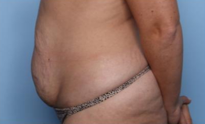 Liposuction Before & After Patient #33240