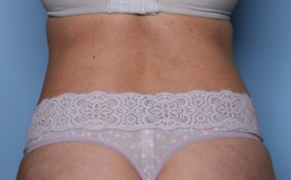 Liposuction Before & After Patient #33240