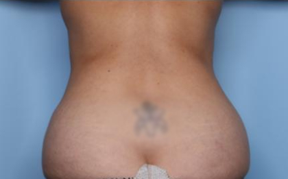 Liposuction Before & After Patient #33240