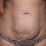 Liposuction Before & After Patient #33240