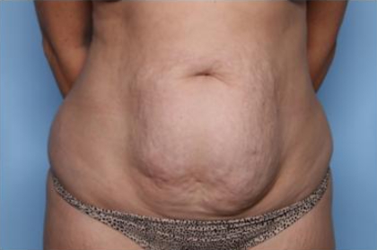 Liposuction Before & After Patient #33240