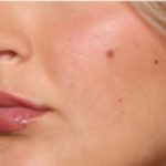 Lip Filler Before & After Patient #33260