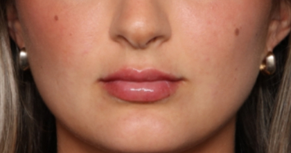 Lip Filler Before & After Patient #33260
