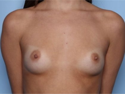 Breast Augmentation Before & After Patient #33253