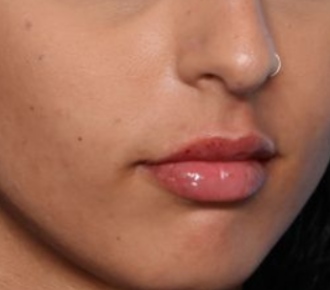 Lip Filler Before & After Patient #33276