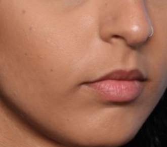 Lip Filler Before & After Patient #33276