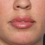 Lip Filler Before & After Patient #33269